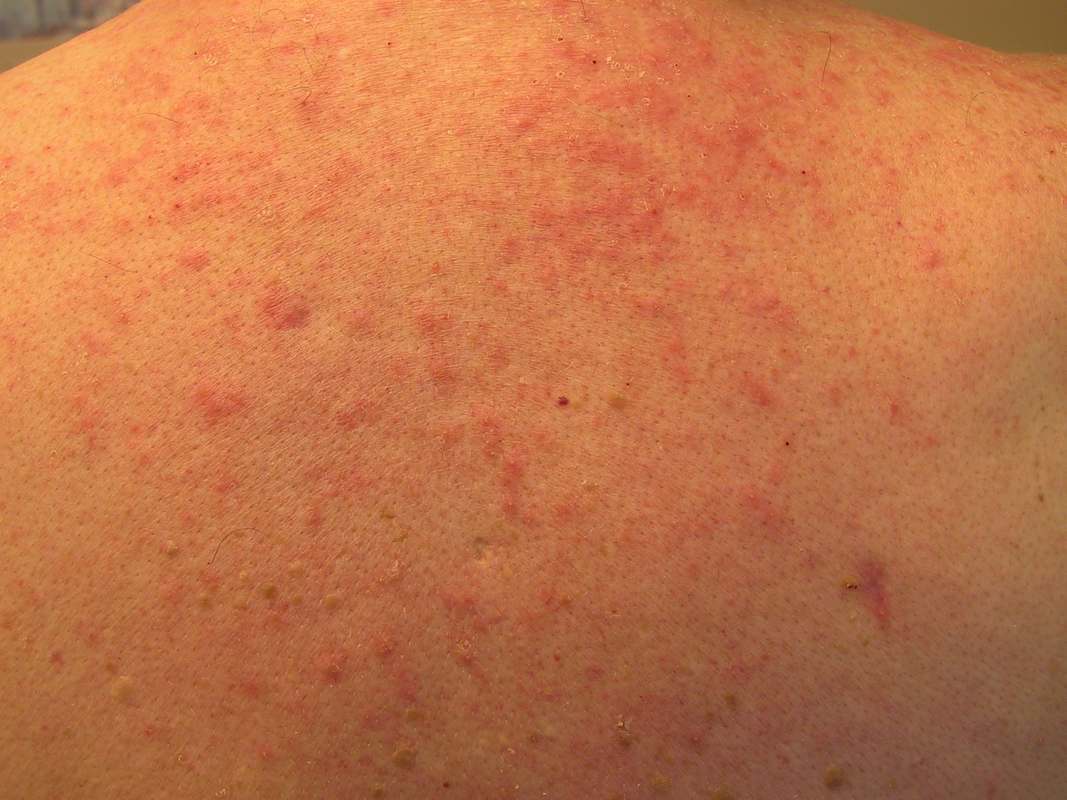Hot tub folliculitis - Hình ảnh minh họa